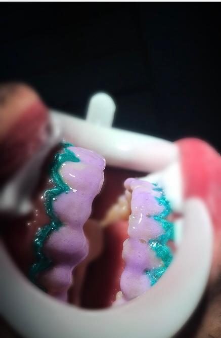 Enceramento de planejamento do sorriso sobre o modelo de gesso