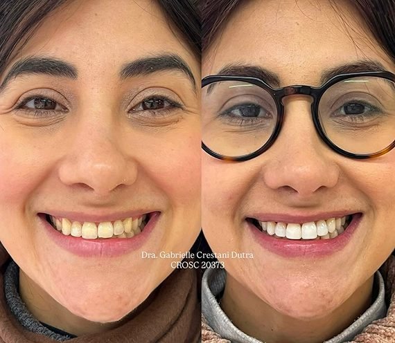 Paciente sorrindo antes e depois de facetas em resina