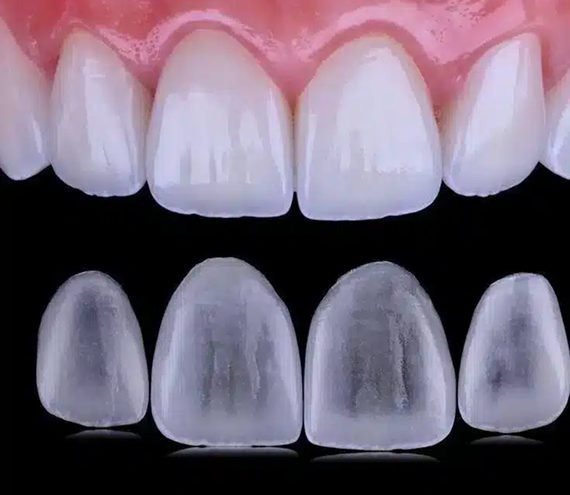 Lentes de contato dental em porcelana sobre fundo preto, ao lado dos dentes já finalizados