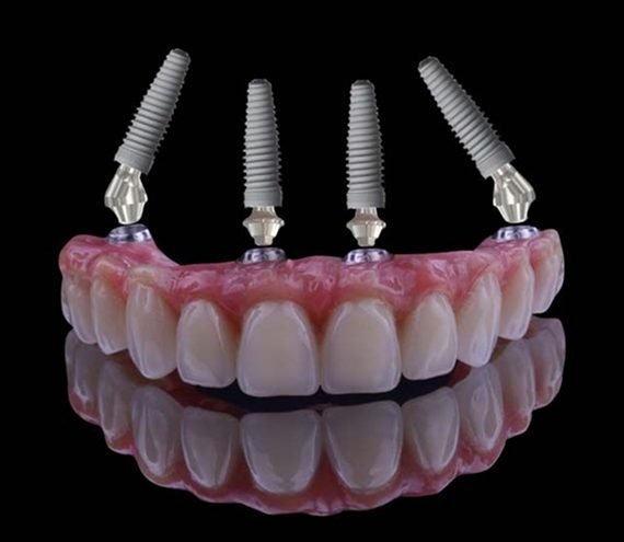 Prótese do tipo protocolo com os componentes sobre quatro implantes